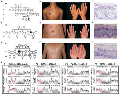 Identification and Splicing Characterization of Novel TMC6 and TMC8 Variants Associated With Epidermodysplasia Verruciformis in Three Chinese Families